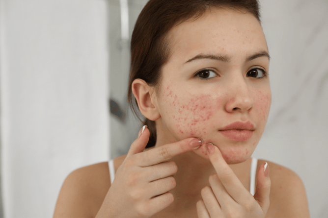 Jak vyčistit pleť od akné návod blog Organic Skin Care